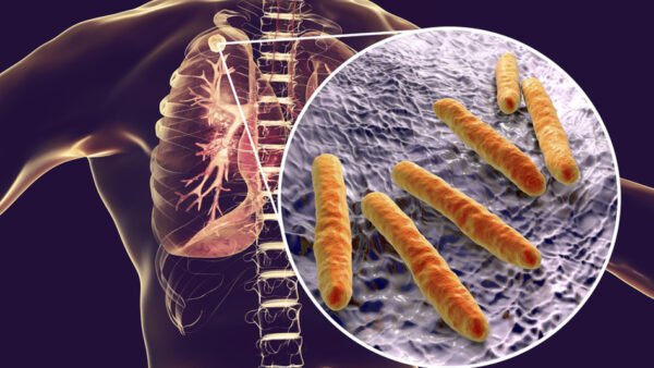 Tubercolosi, allarme ad Alcamo, sono saliti a undici i casi